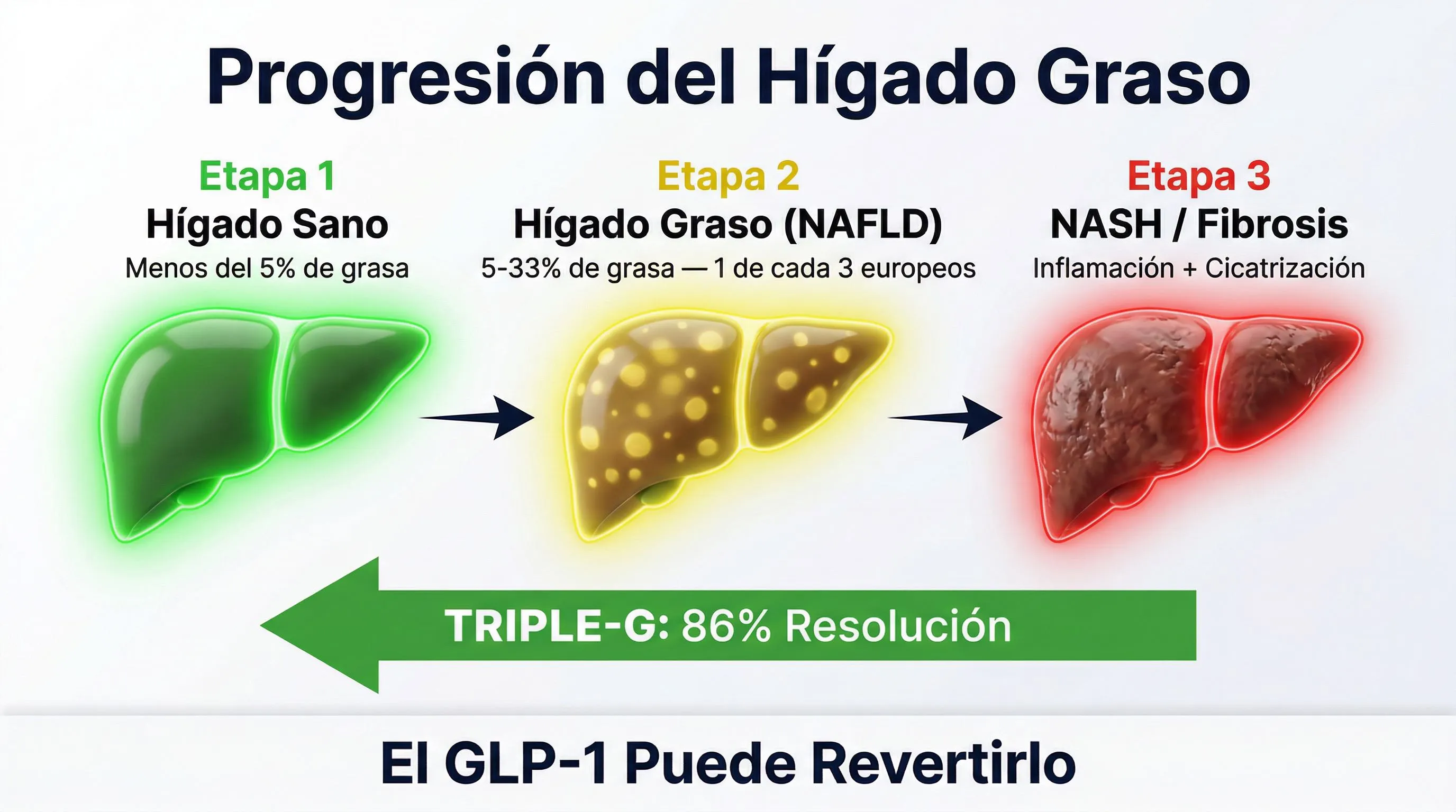 Infografía hígado graso: progresión de sano a NAFLD a NASH y reversión con GLP-1